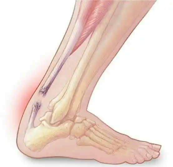 Image from معلومات طبيةصحيه تطوير الذات💡اقتباسات.عبارات.معلومات،نصائح،قصص،قرآن.رسائل.نكت.إذاعة.طبخ.دينيه: 📌 وتر العرقوب هو حبل ليفي قوي يربط العضلات خلف عضلة الربلة إلى عظمة ا...