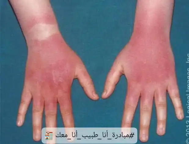 Image from مبادرة انا طبيب انا معك Dr.omarfakih: الجو صيف والشمس حارة والحرارة مرتفعة والتعرض للشمس بطريقة مباشرة عند ...