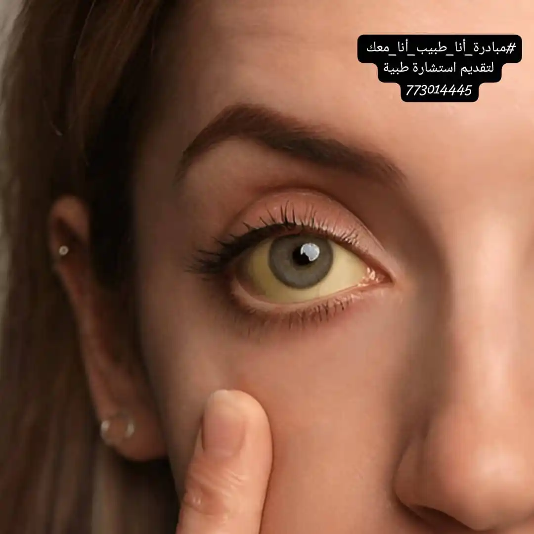 Image from مبادرة انا طبيب انا معك Dr.omarfakih: اصفرار الجلد والعينين... هل يجب القلق؟ عندما تلاحظ أن بشرتك أو بياض ع...