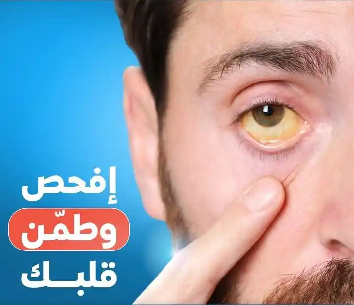 Image from مجموعة مختبرات دار الصحه الدوليه فرع الدمنه (7): اصفرار الجلد والعينين... هل يجب القلق؟ عندما تلاحظ أن بشرتك أو بياض ع...