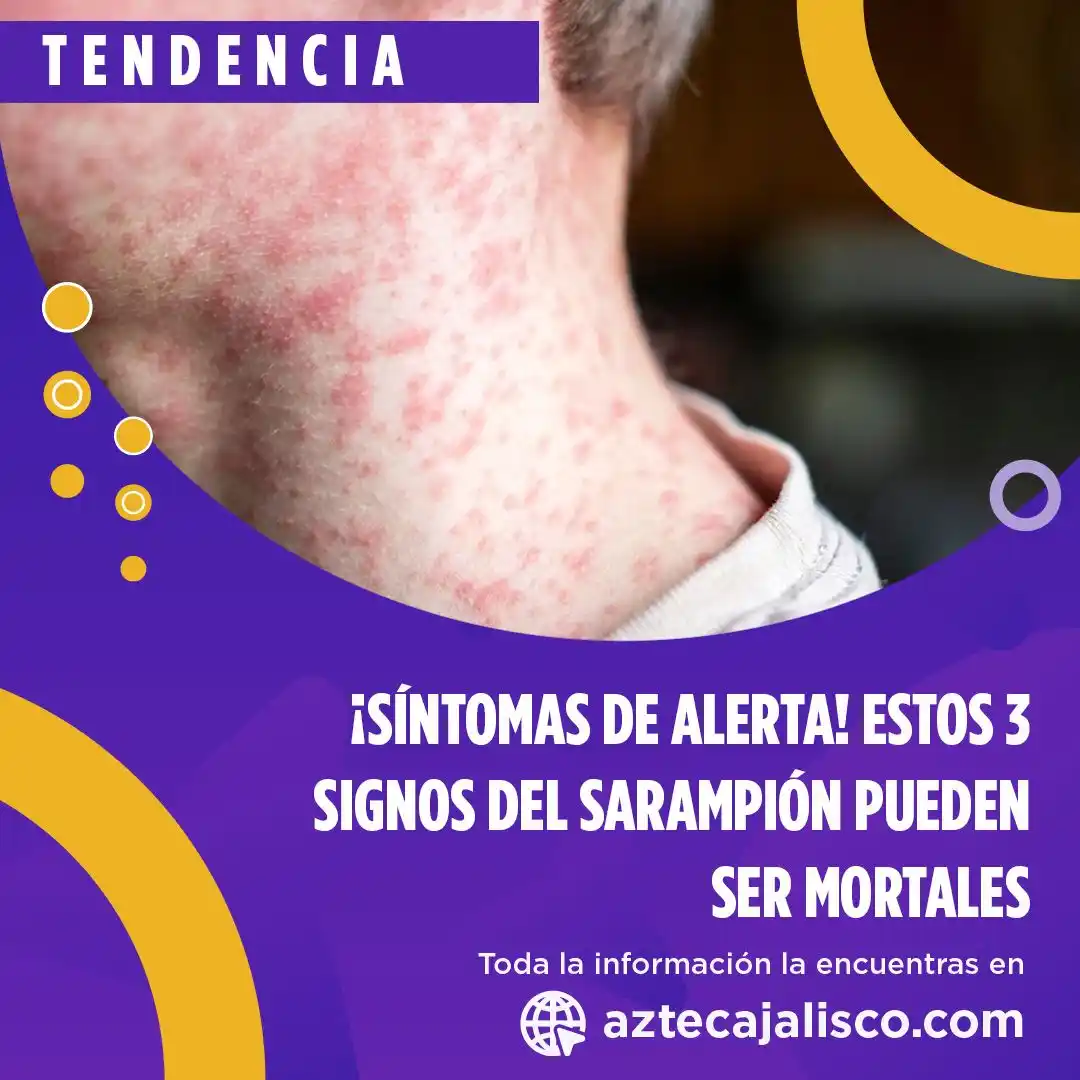 Image from TV Azteca Jalisco : ¡Mucho cuidado con estos síntomas!👀🚨 Podrían ser signos de sarampión...