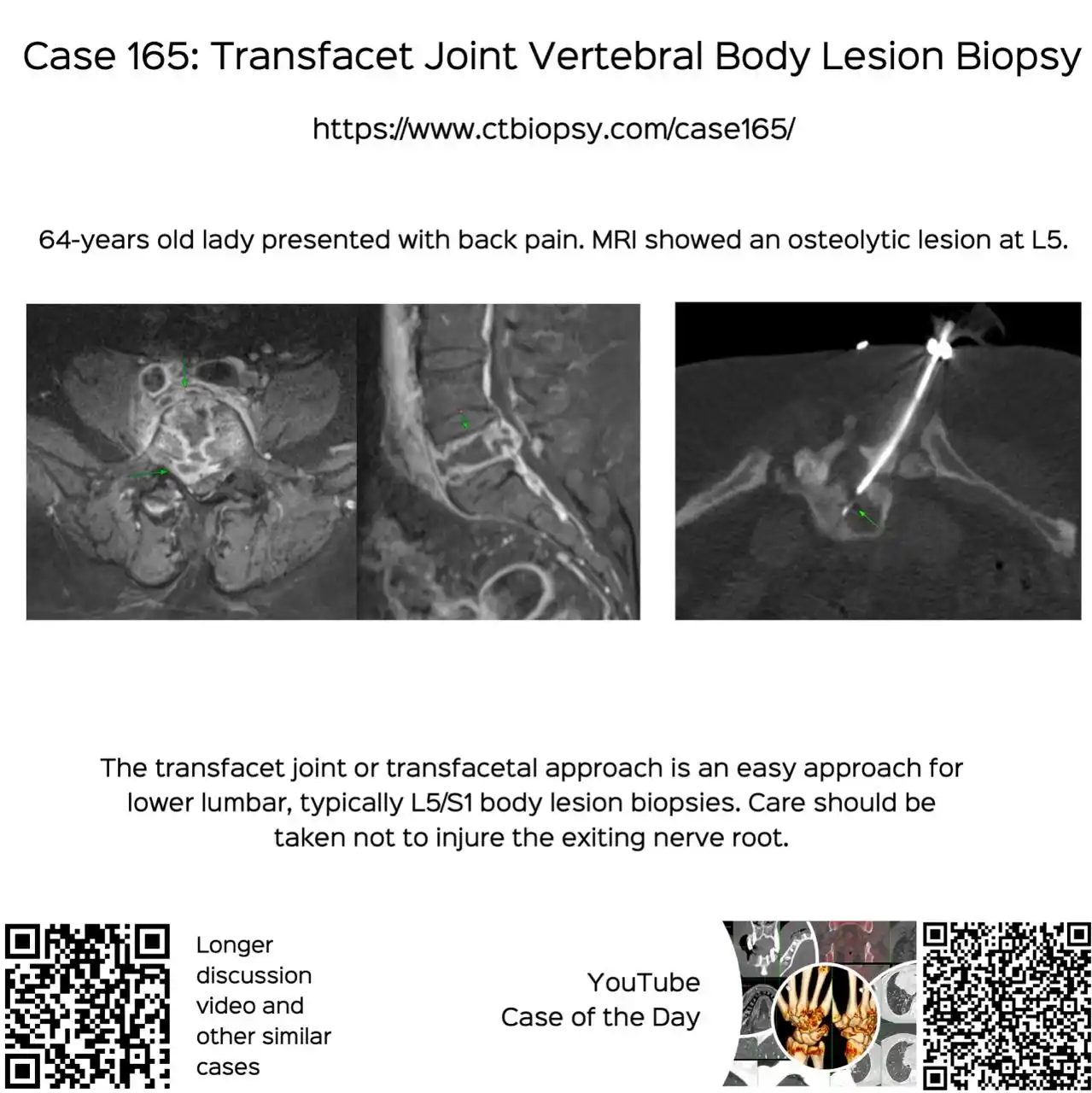 Image from Bhavin Jankharia's Posts - Mainly Radiology, Sometimes Non-Radiology and Non-Medical: Case 165: Transfacet Joint Vertebral Body Lesion Biopsy
  64-yrs old w...