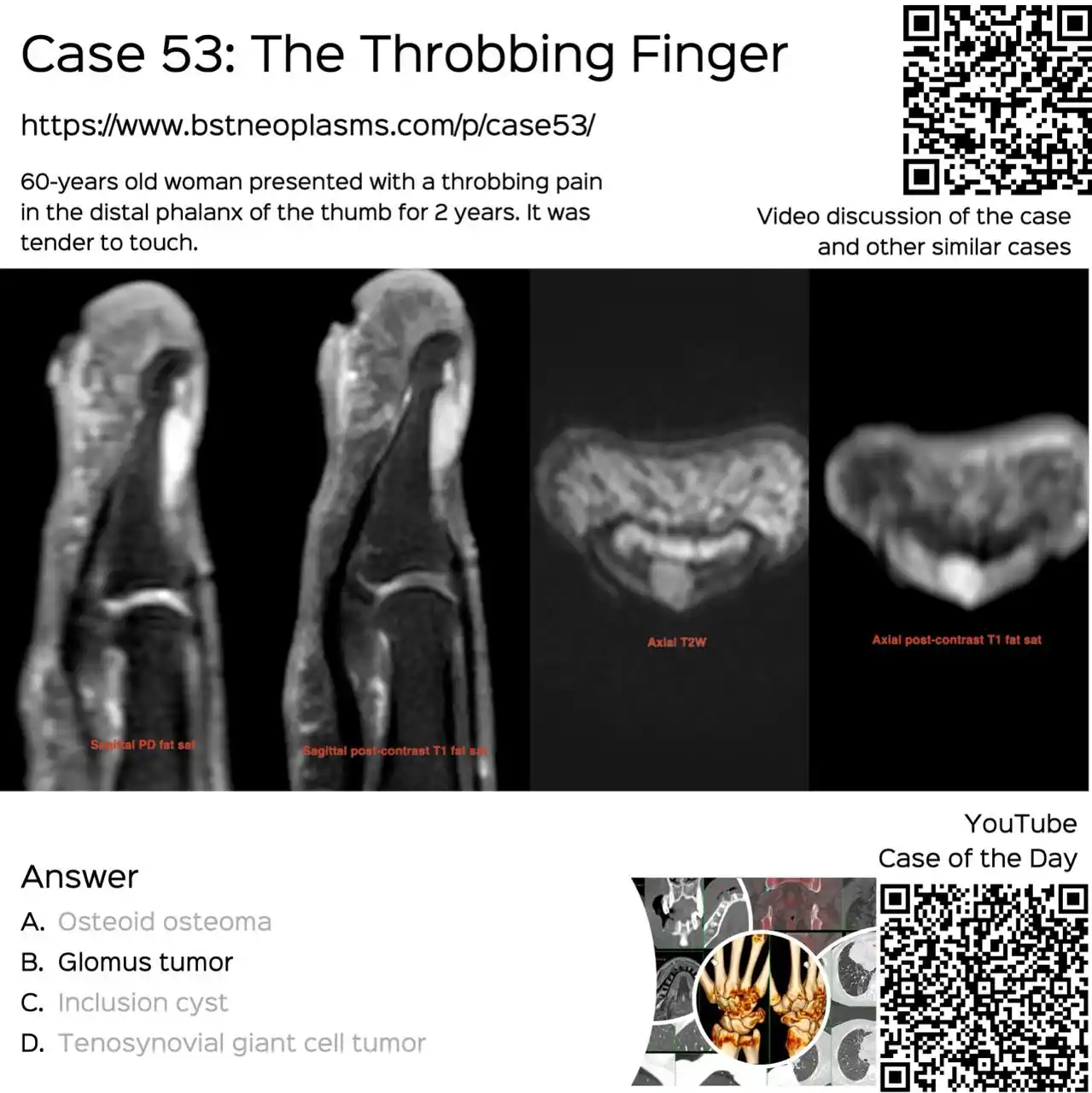 Image from Bhavin Jankharia's Posts - Mainly Radiology, Sometimes Non-Radiology and Non-Medical: Case 53 - The Throbbing Finger  60-years old woman presented with a th...