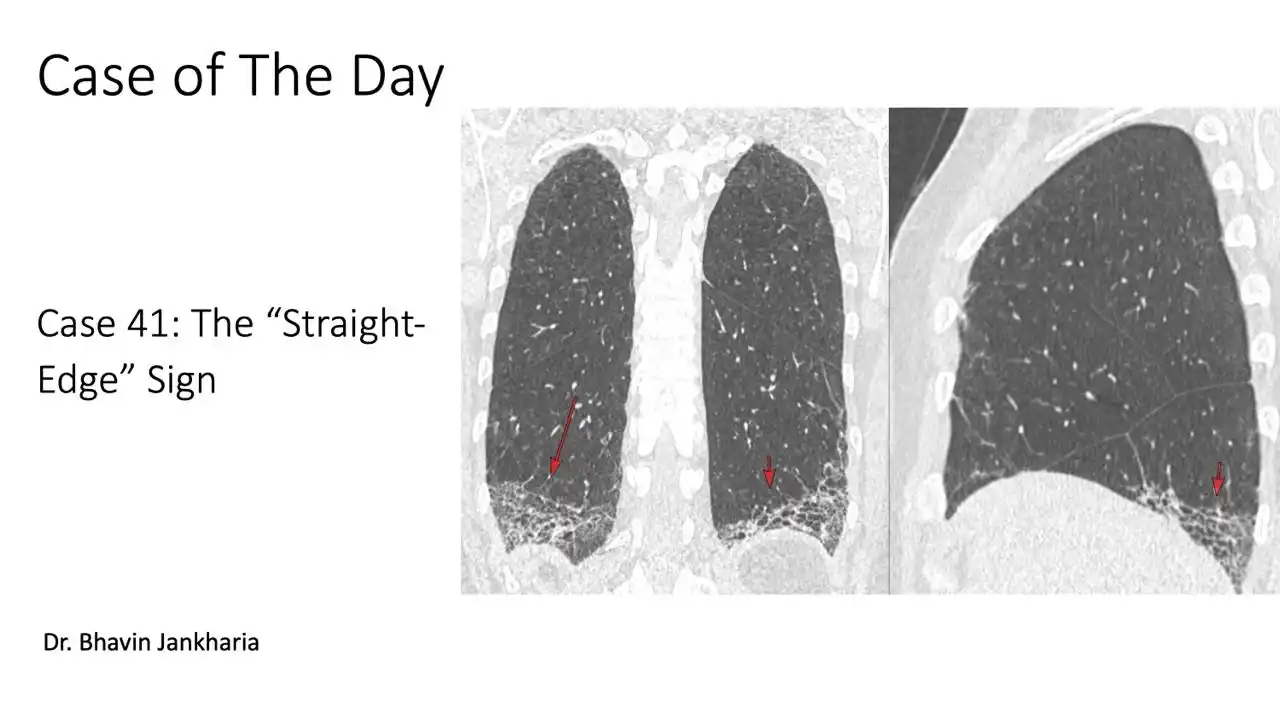 Image from Bhavin Jankharia's Posts - Mainly Radiology, Sometimes Non-Radiology and Non-Medical: Case of the Day - 041 - 2025 05 27 - The "Straight-Edge" Sign 54-year...