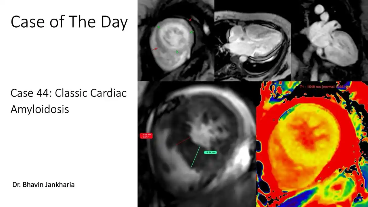 Image from Bhavin Jankharia's Posts - Mainly Radiology, Sometimes Non-Radiology and Non-Medical: Case of the Day - 042 - 2025 05 28 - Classic Cardiac Amyloidosis 55-y...