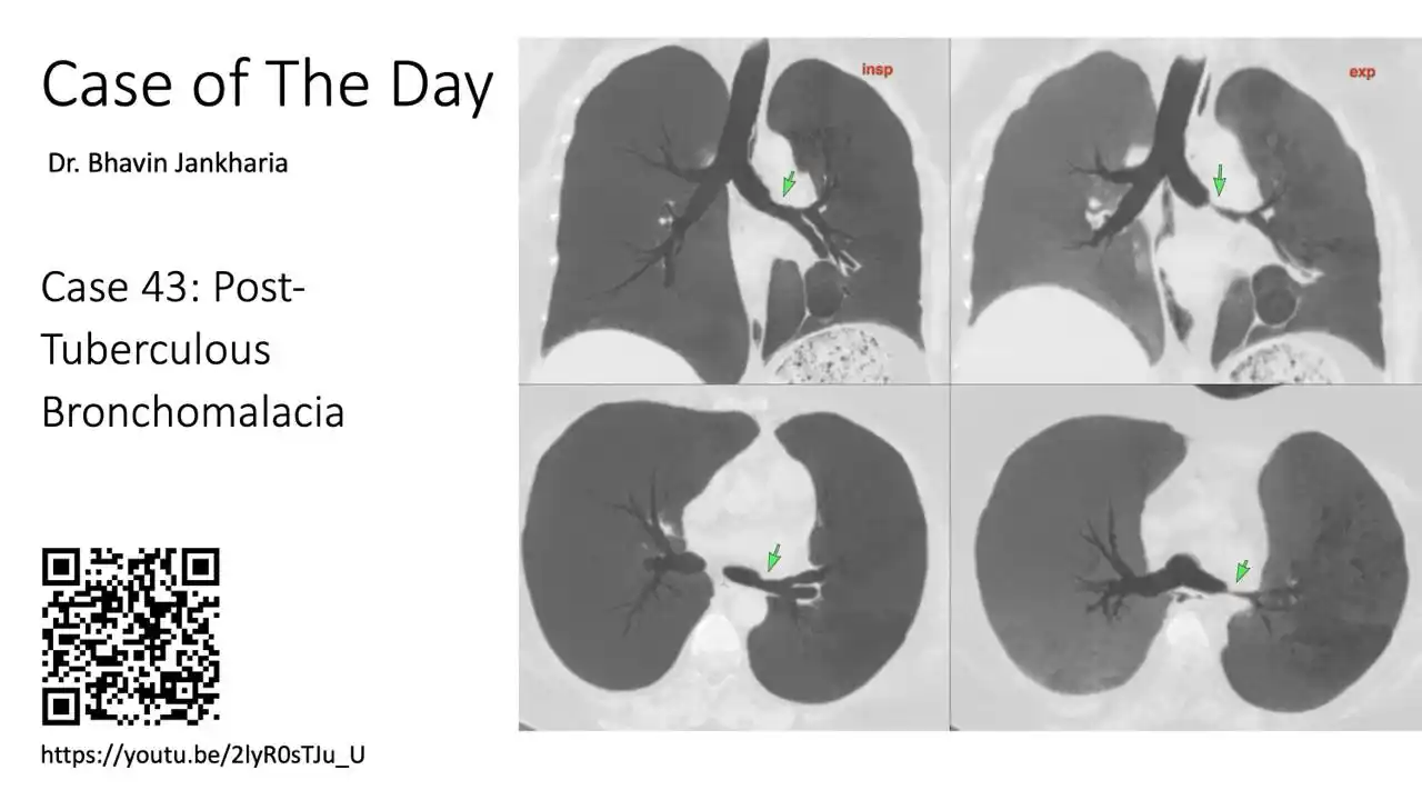 Image from Bhavin Jankharia's Posts - Mainly Radiology, Sometimes Non-Radiology and Non-Medical: Case of the Day - 043 - 2025 05 29 - Post-Tuberculous Bronchomalacia  ...