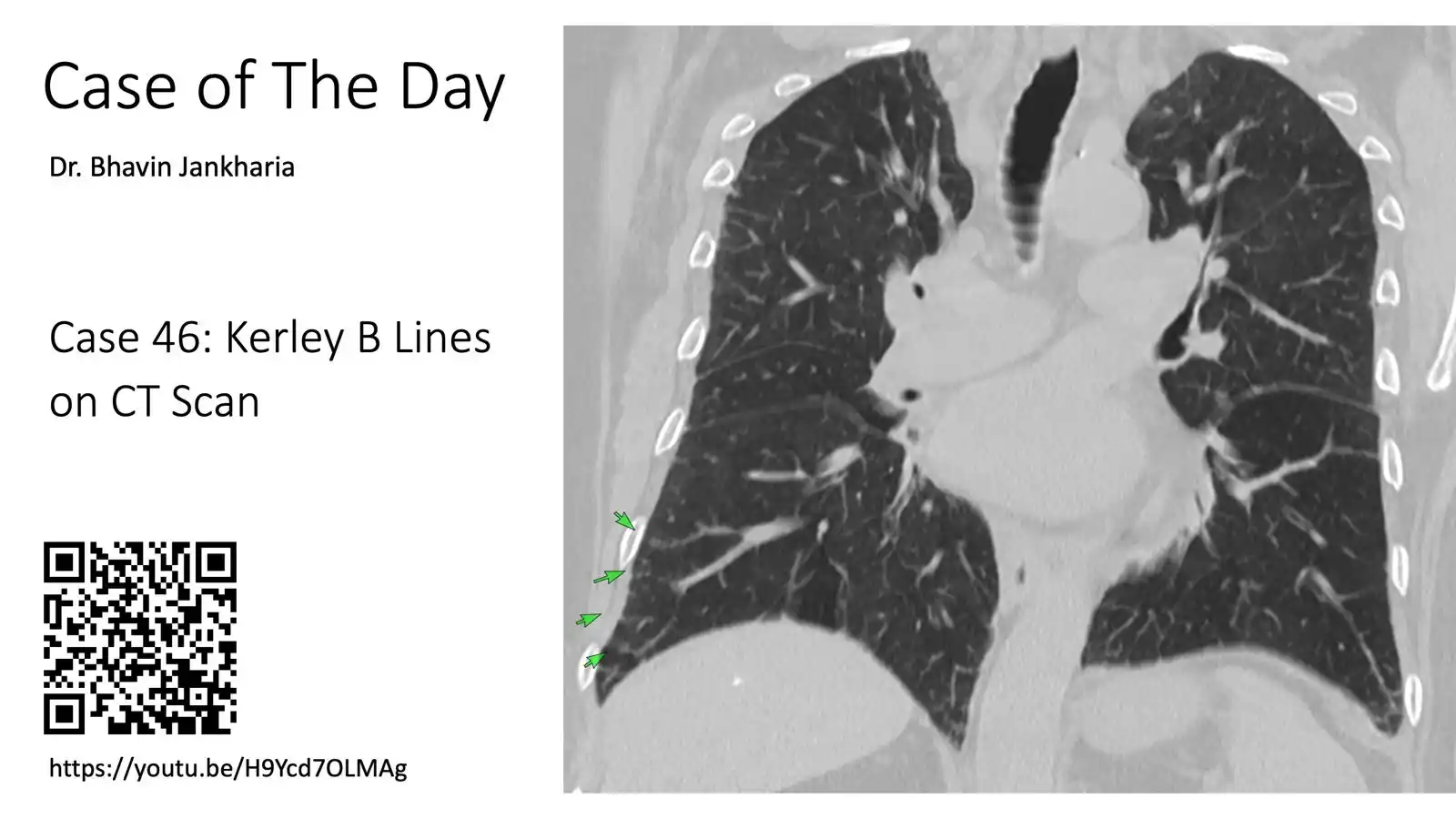 Image from Bhavin Jankharia's Posts - Mainly Radiology, Sometimes Non-Radiology and Non-Medical: Case of the Day - 046 - Kerley B Lines on CT Scan 79-years old with d...