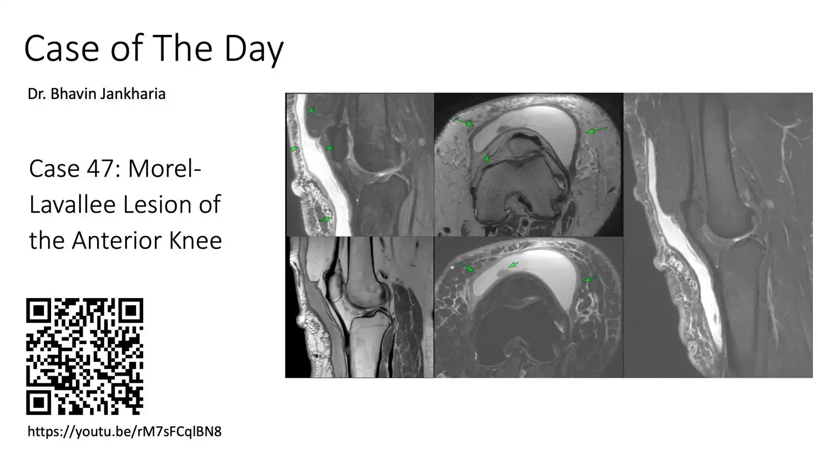 Image from Bhavin Jankharia's Posts - Mainly Radiology, Sometimes Non-Radiology and Non-Medical: Case of the Day - 047 - Morel-Lavallee Lesion of the Anterior Knee 29...