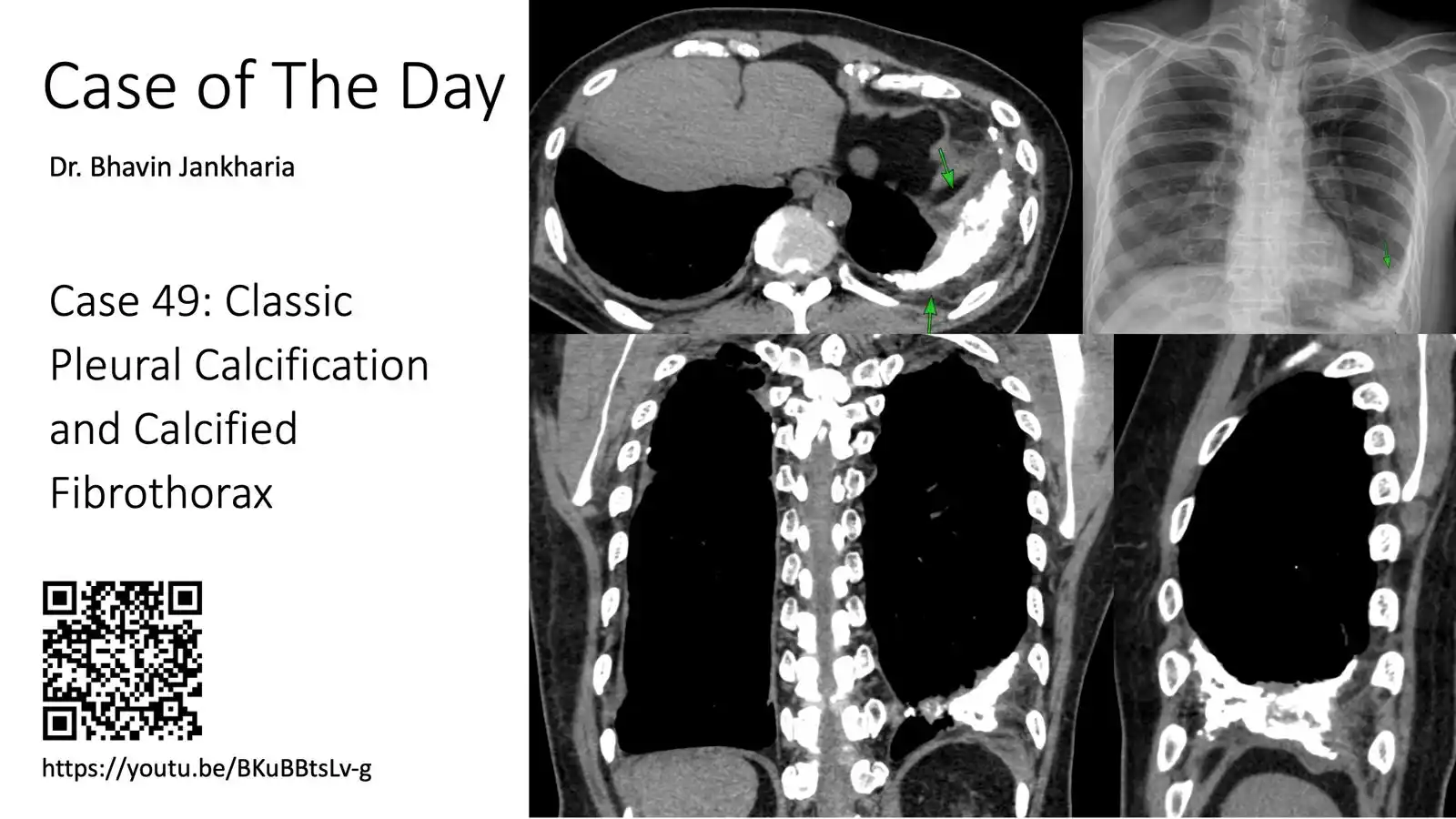 Image from Bhavin Jankharia's Posts - Mainly Radiology, Sometimes Non-Radiology and Non-Medical: Case of the Day - 049 - Classic Pleural Calcification and Calcified FI...