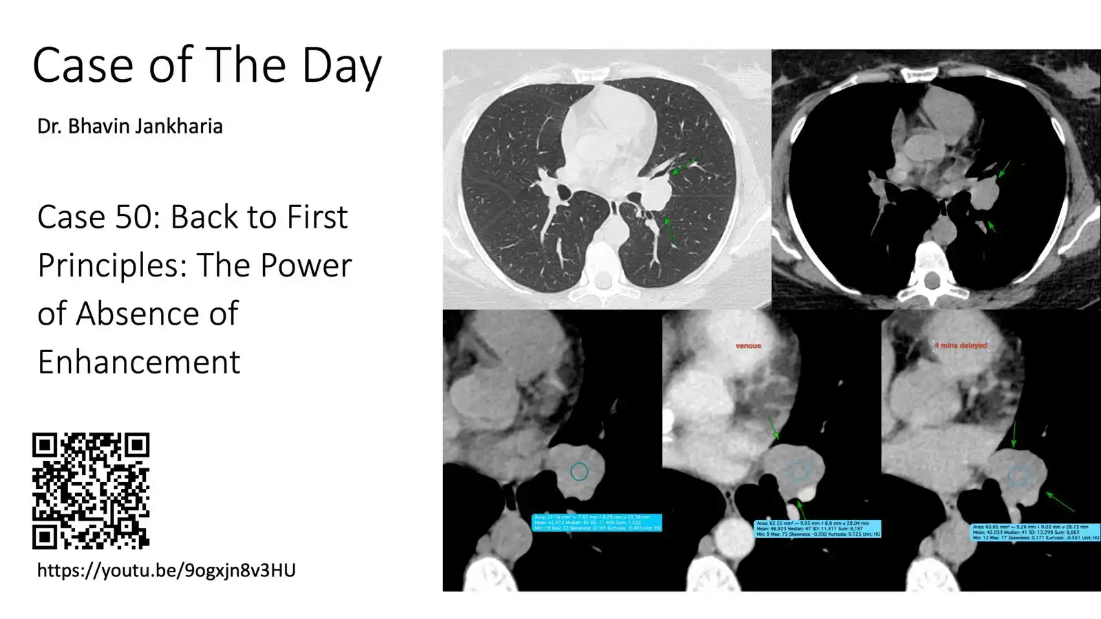 Image from Bhavin Jankharia's Posts - Mainly Radiology, Sometimes Non-Radiology and Non-Medical: Case of the Day - 050 - Back of First Principles - The Power of Absenc...