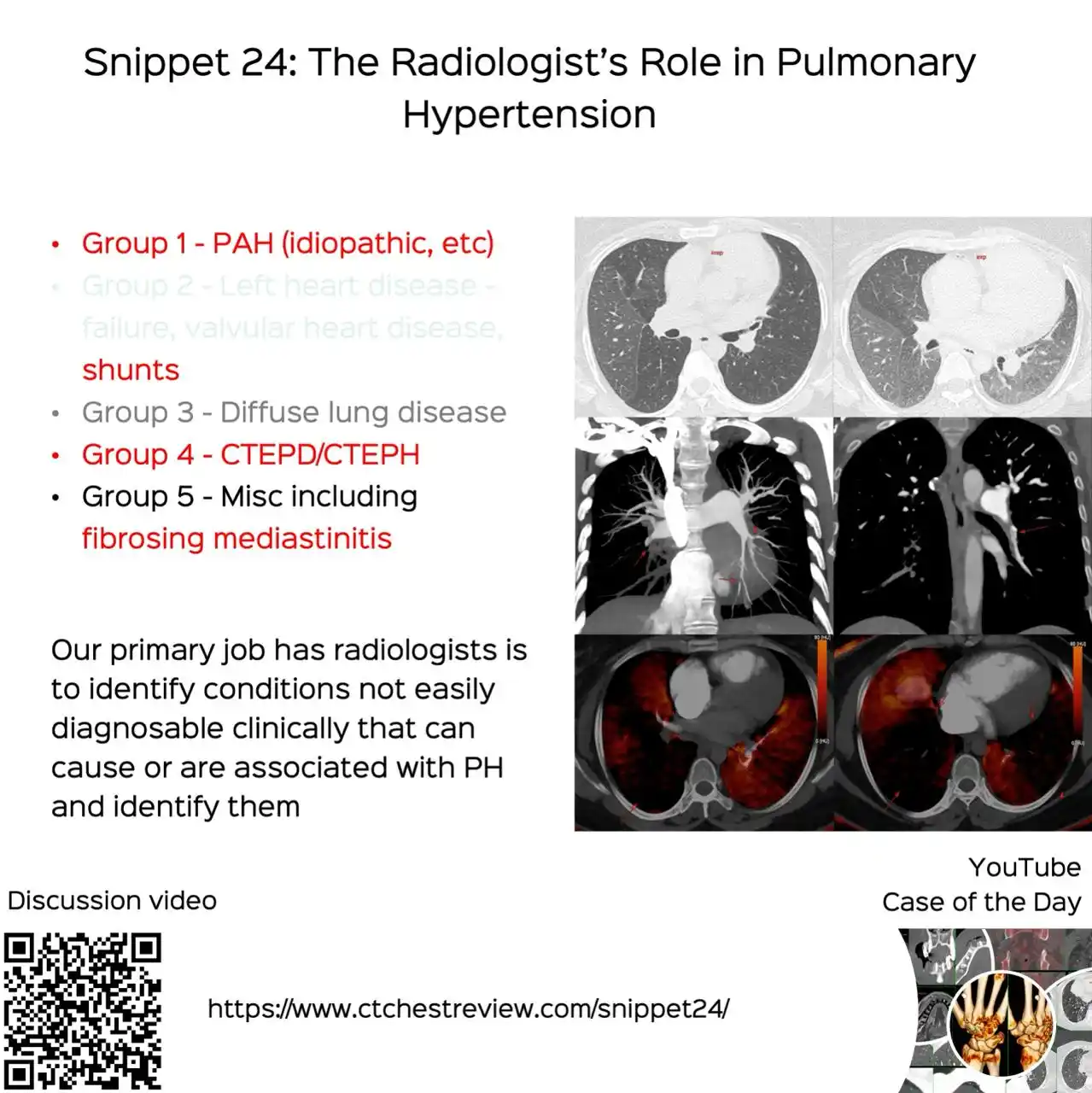 Image from Bhavin Jankharia's Posts - Mainly Radiology, Sometimes Non-Radiology and Non-Medical: Snippet 24: The Radiologist's Role in Pulmonary Hypertension  What is ...