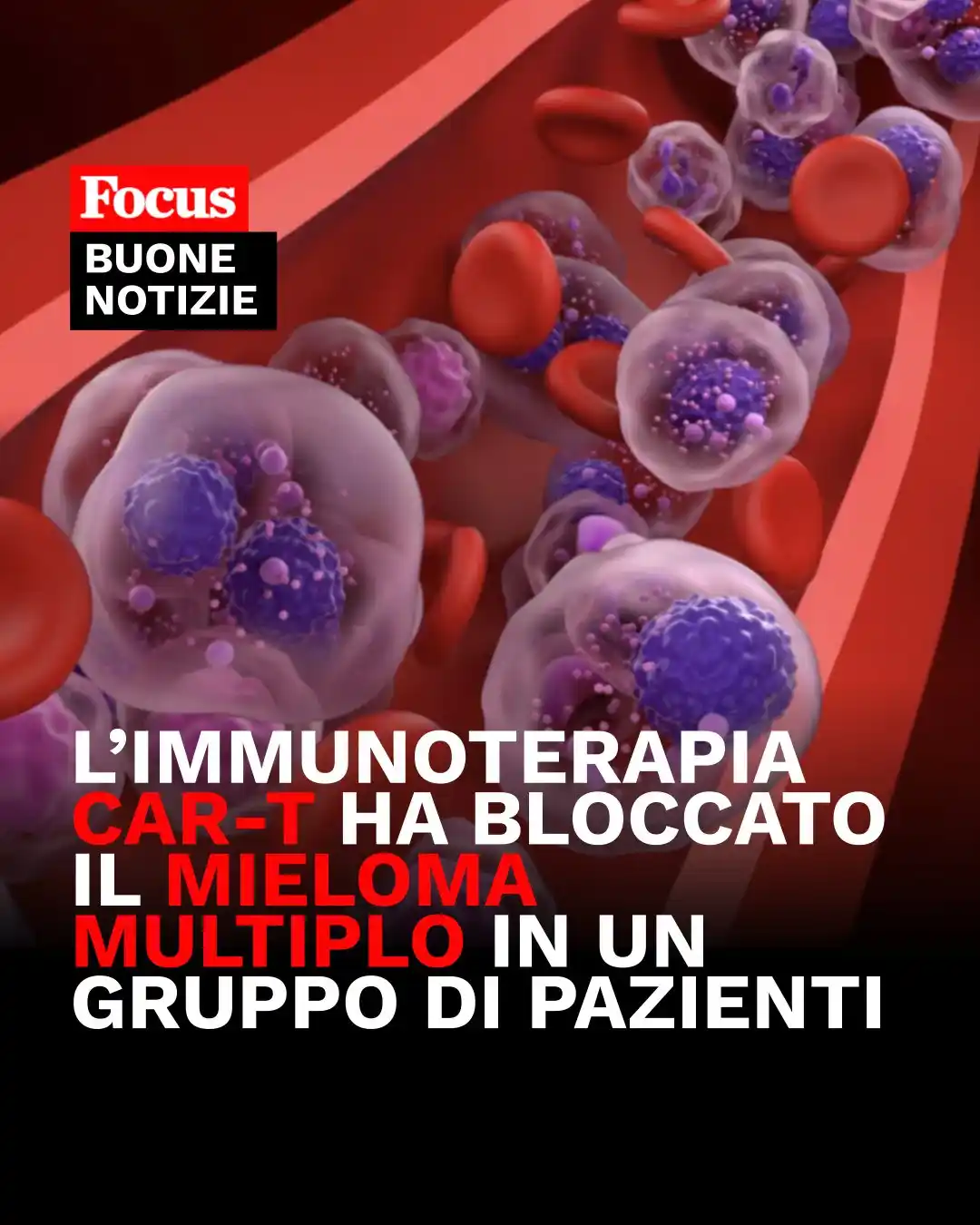 Image from Focus: 🎯 Contro il *mieloma multiplo*, un risultato senza precedenti: in un ...