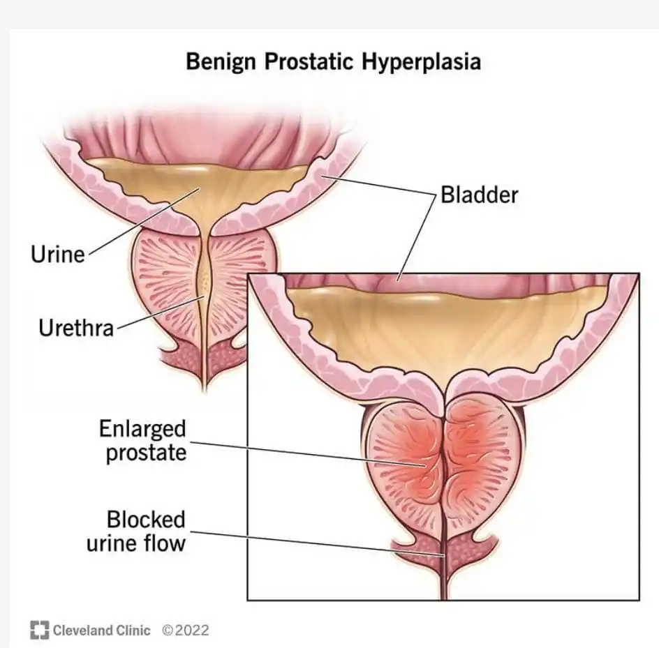Image from Herbal Clinic: WHAT CAUSES IT TO GROW BIGGER? The exact cause is not known, however ...