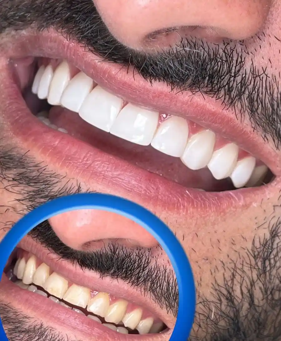 Image from Bruno Assunção : 🎯 VENHA CONHECER O PROTOCOLO RH EM FACETAS DE RESINA! O sorriso dos ...