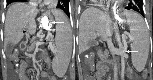 Image from e-Radiologia: [einstein - São Paulo] Uso do acesso transesplênico no tratamento do s...