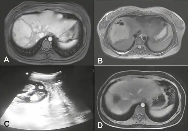 Image from e-Radiologia: [Radiologia Brasileira] Abscesso hepático piogênico tardio após emboli...