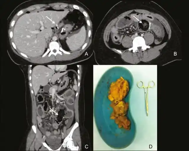Image from e-Radiologia: [Radiologia Brasileira] Obstrução intestinal por fitobezoar em pacient...