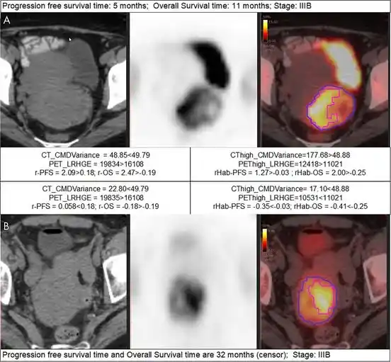 Image from e-Radiologia: [Radiology: Artificial Intelligence] 18F-FDG PET/CT Habitat Radiomics ...