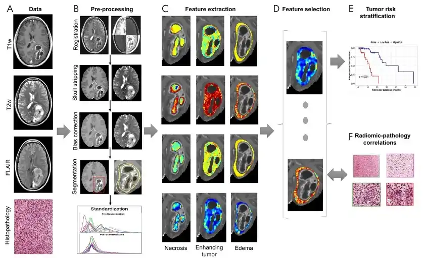Image from e-Radiologia: [Radiology: Artificial Intelligence] Tumor Habitat–derived Radiomic Fe...