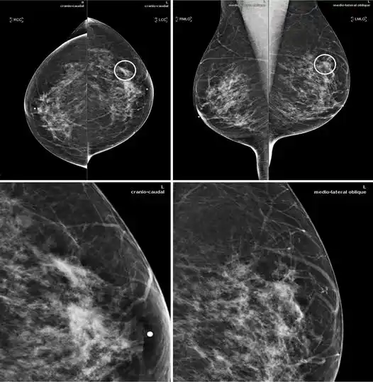 Image from e-Radiologia: [Radiology: Artificial Intelligence]Improving Breast Cancer Detection ...