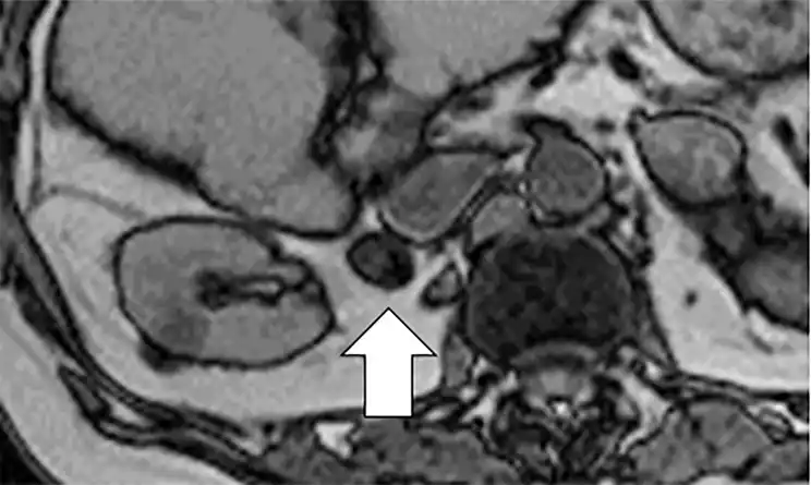 Image from e-Radiologia: [Radiology: Imaging Cancer] Utility of T2-weighted MRI to Differentiat...