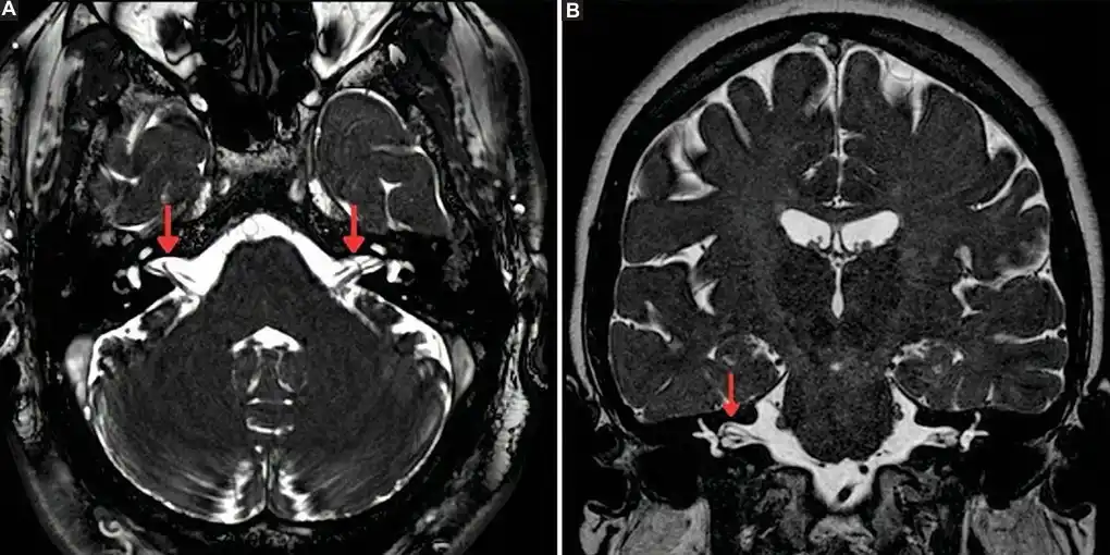 Image from e-Radiologia: [Revista Argentina de Radiología] Correlación clínico-radiológica de l...