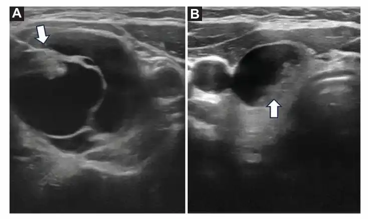 Image from e-Radiologia: [Revista Argentina de Radiología] Rendimiento de las escalas ATA vs. A...