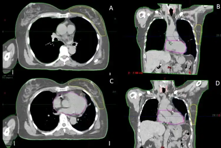 Image from e-Radiologia: [Revista Brasileira de Física Médica] Impacto da Técnica de Retenção d...