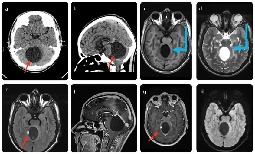 Image from e-Radiologia: [Revista Colombiana de Radiología] Diagnóstico diferencial de las lesi...