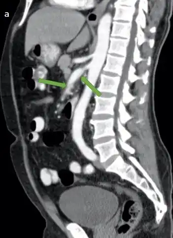 Image from e-Radiologia: [Revista Colombiana de Radiología] Manifestaciones imagenológicas pulm...