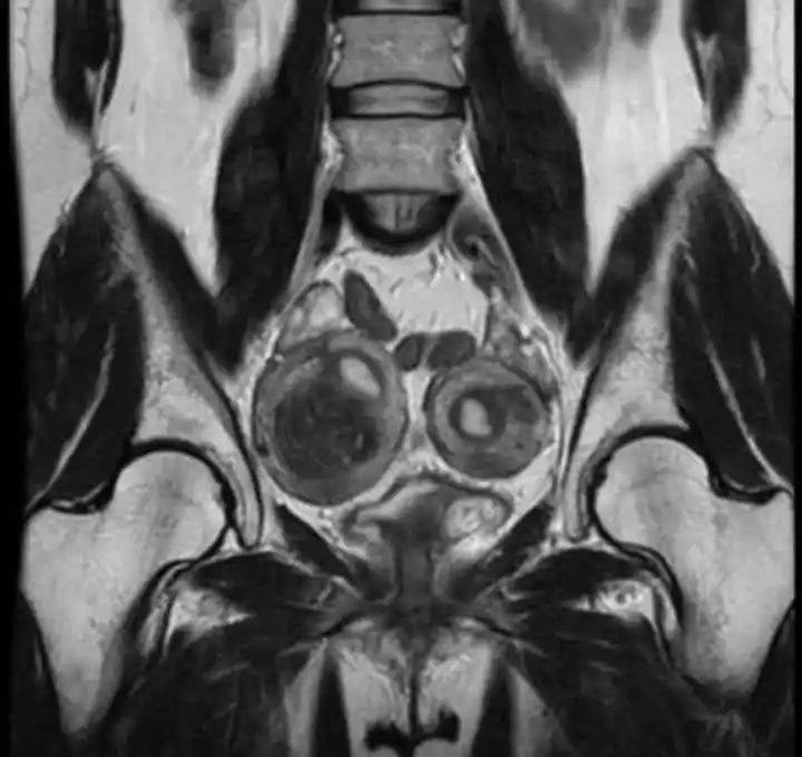 Image from Dopamine Clinical: حالة طبية نادرة: رحم مزدوج لم يُكتشف حتى الولادة! فتاة في الرابعة عشر...