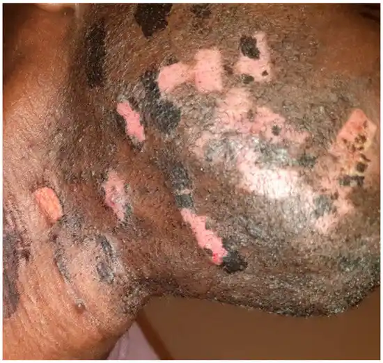 Image from 🌎🧑‍🦰 Iglesia del Espacio Increado ( de Fyrmh ) [ en internet ]: Peste Negra (un-1353):  La pandemia de peste bubónica más devastadora,...