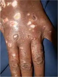 Image from 🌎🧑‍🦰 Iglesia del Espacio Increado ( de Fyrmh ) [ en internet ]: Peste Negra (un-1353):  La pandemia de peste bubónica más devastadora,...