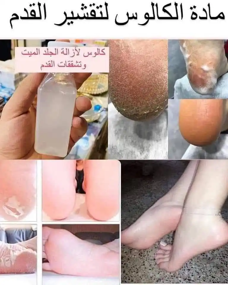 Image from Tb مًجّـمًعٌ تٌـوٌتٌـ 🌸🔥: اقوى مقشر للقدم نتيجه من اول استخدام ازالة الجلد الميت والتشققات ح ت...