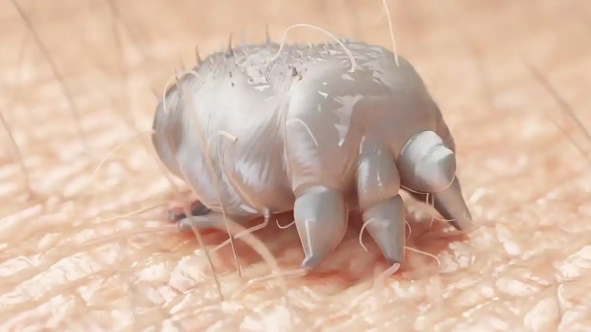 Image from Tgcom24: *Allarme scabbia, il microbiologo a Tgcom24: i sintomi, come si diffon...