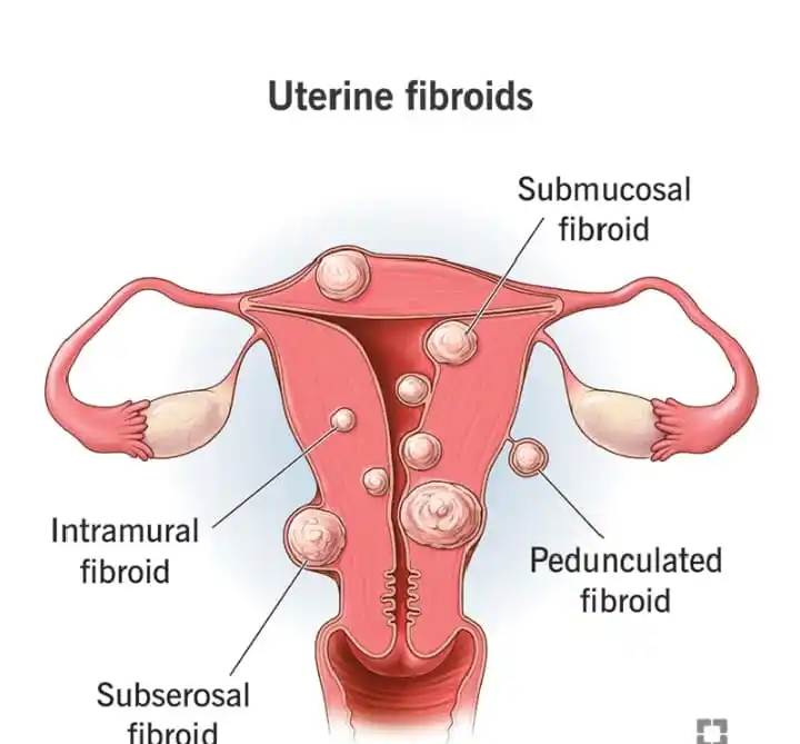 Image from Zoomic Media (8): What were your first signs of uterine fibroids? The most common sympto...