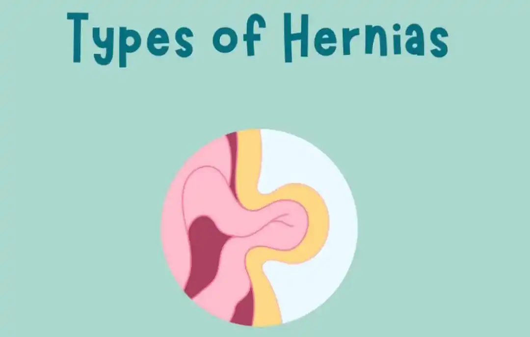 Image from WeTheDoctors™: Hernia and Its Types By WeTheDoctors A hernia is a condition where ...