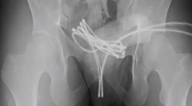Image from Daily Mail: Man, 21, hospitalised due to risky 'sounding' sex act involving a USB ...