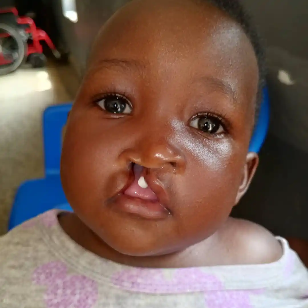 Image from NutritionistKD: Do you know of anyone with such? Did you know that *Clefts* can be re...