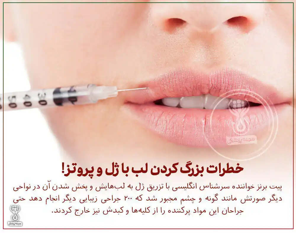 Image from داکتر مرجان معلومات طبی🩺: خطرات بزرگ کردن لب با ژل و پروتز !💋 ▫️پیت برنز خواننده سرشناس انگلیس...