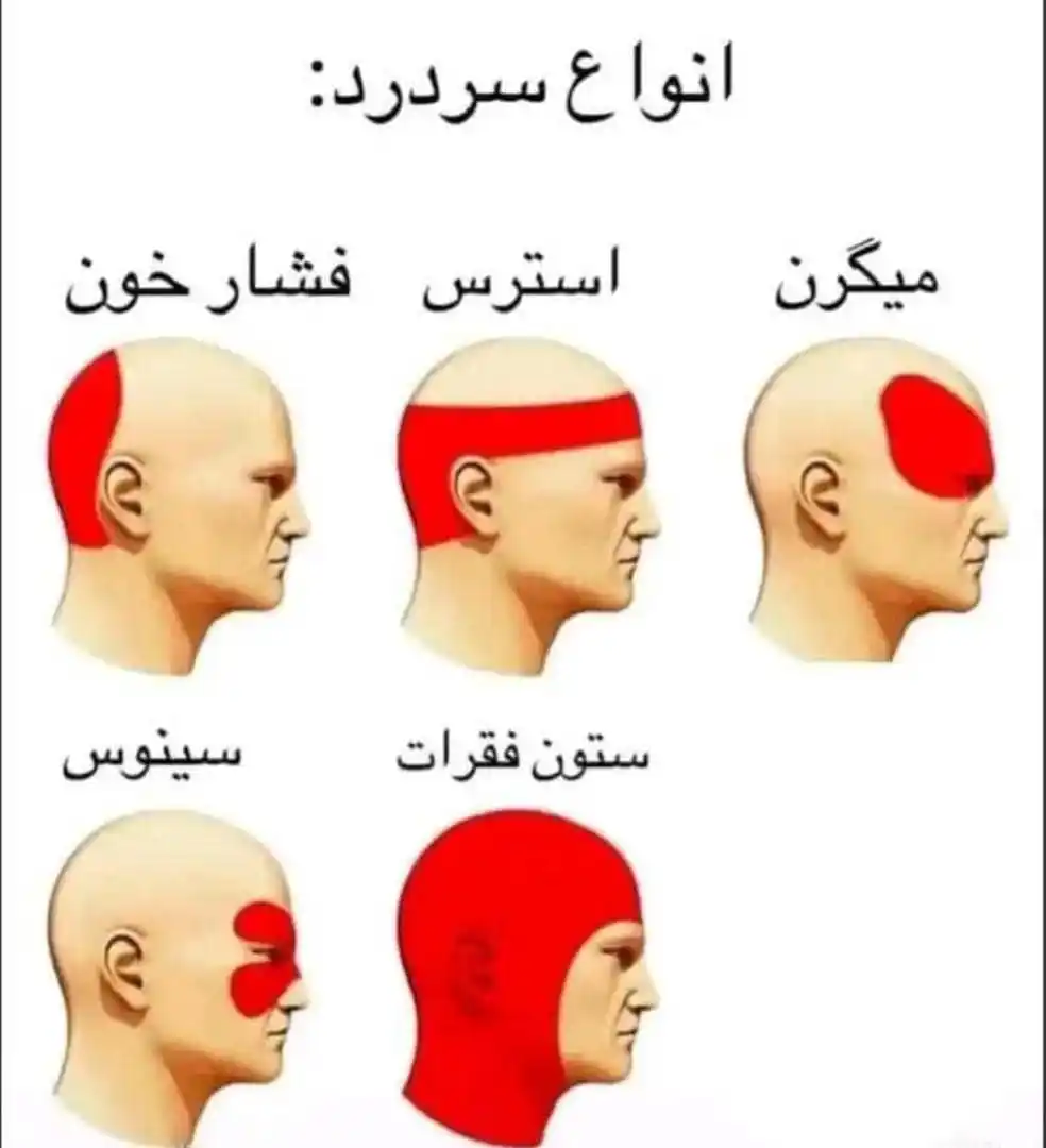 Image from Doctor Ekhlas 👸🏻🥼🫀: انواع سردردی و علت های آن! سردرد یکی از مشکلات شایعی است که تقریباً ...