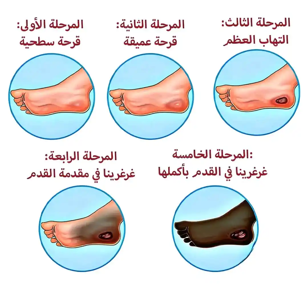 Image from كل يوم معلومه طبية: 🦶💉 "جرح بسيط؟ عندك سكر؟ متستهونش!" ناس كتير فاكرة إن الجرح لما يبقى ...