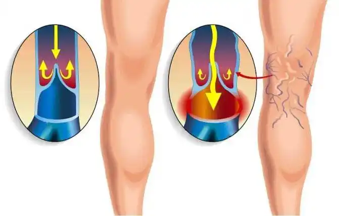 Image from HEALTH AND LIFE WORLD(HLW): Improve blood circulation in the legs Doctors unanimously assure that...