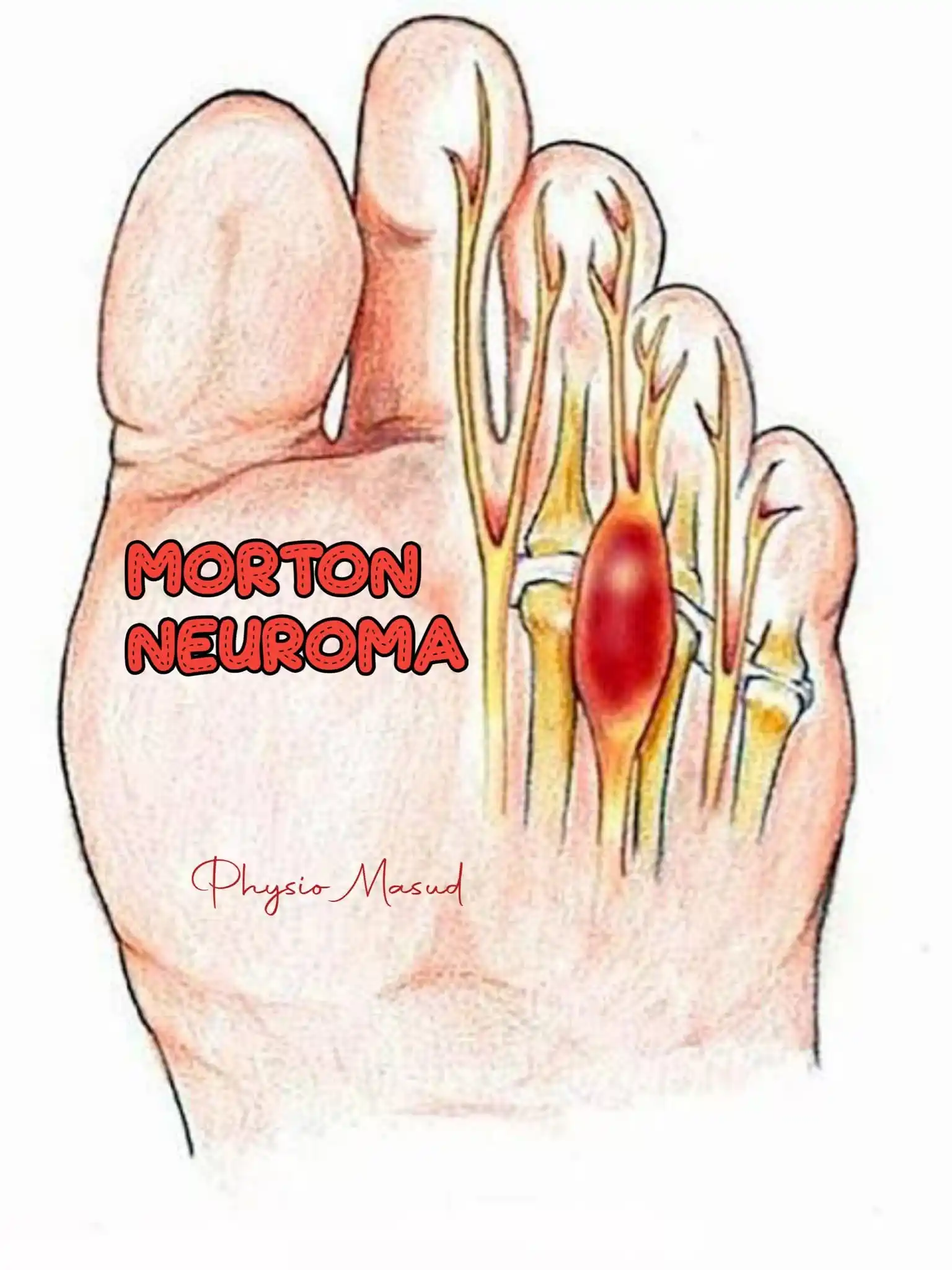 Image from Doctor Ekhlas 👸🏻🥼🫀: 🦶 Morton’s Neuroma ( Everything you know here) 📘 Definition: Morto...