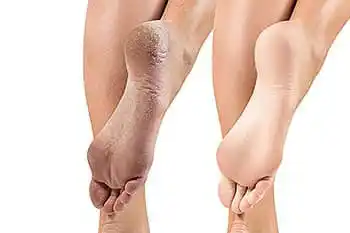 Image from HEALTH AND LIFE WORLD(HLW): *SKIN FISSURES 🦶* These are areas of dried, cracked skin that thick...