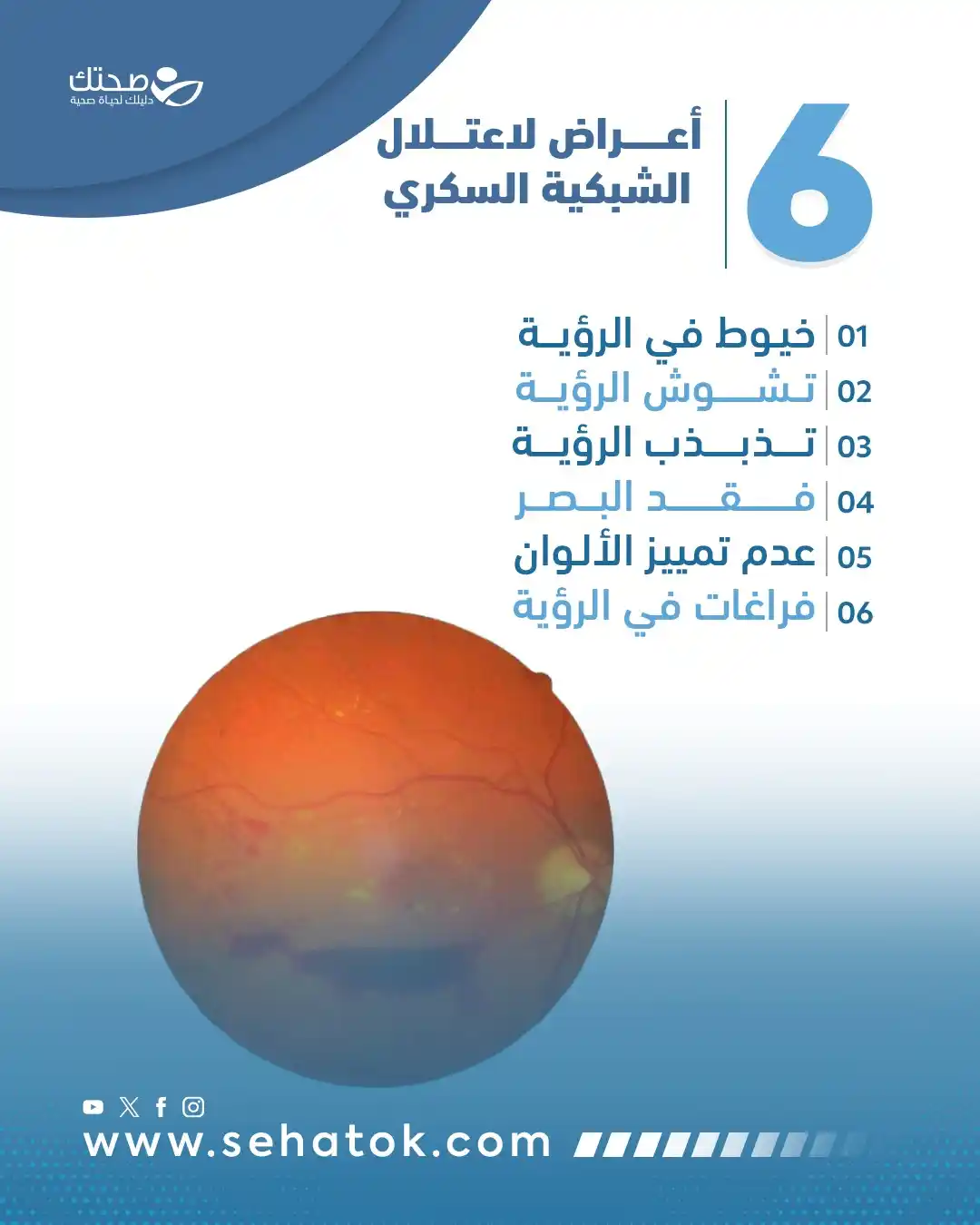 Image from موقع صحتك: اعتلال الشبكية السكري من المضاعفات الصامتة والخطيرة لداء السكري، وقد ي...