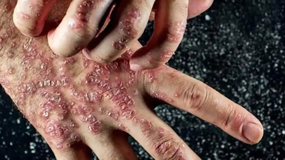 Image from Jobs Adda Coaching: Autoimmune disorder...
