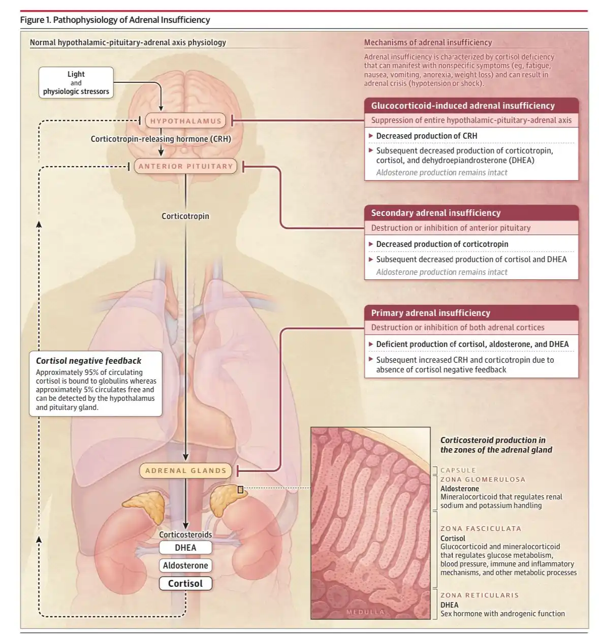 Image from Medicina Basada En Evidencia⚕️: La insuficiencia suprarrenal es un síndrome de deficiencia de cortisol...