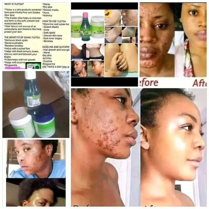 Image from HIP N BUM FLAT TUMMY PRODUCTS NA MAI T: 📌Are you struggling with stretch marks wrinkles dark sports pimples ,...