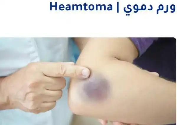 Image from QURAN معلومات طبية ونصائح عامه 🤍: 🔴اليماتوما أو الورم الدموي (بالإنجليزية: Hematoma) بأنه عبارة عن خروج...